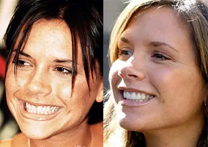 Victoria Beckham: Πόσο την άλλαξαν οι πλαστικές επεμβάσεις όλα αυτά τα χρόνια; Victoria Beckham: Πόσο την άλλαξαν οι πλαστικές επεμβάσεις όλα αυτά τα χρόνια;